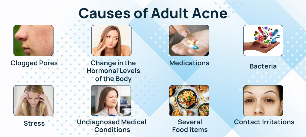 Causes of Adult Acne