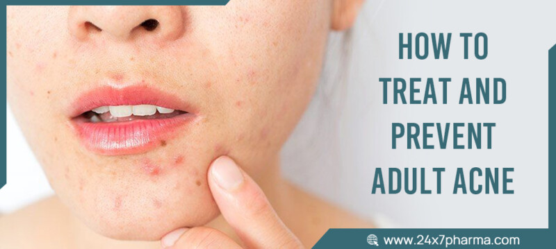 How to Treat and Prevent Adult Acne