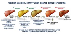 fatty liver disease 